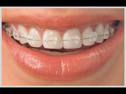 Ceramic-braces-img