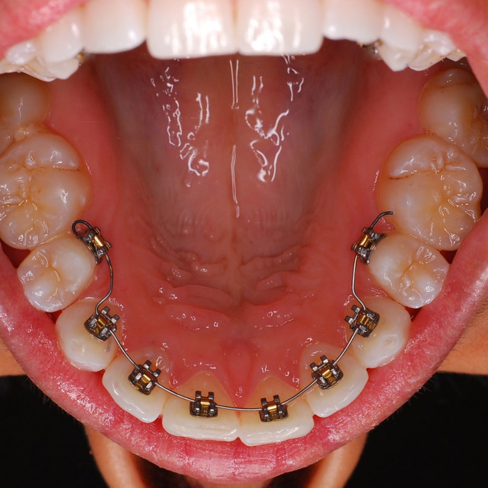 Lingual-Braces-img