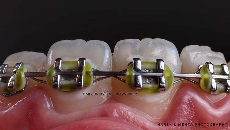 Metal-Braces-img